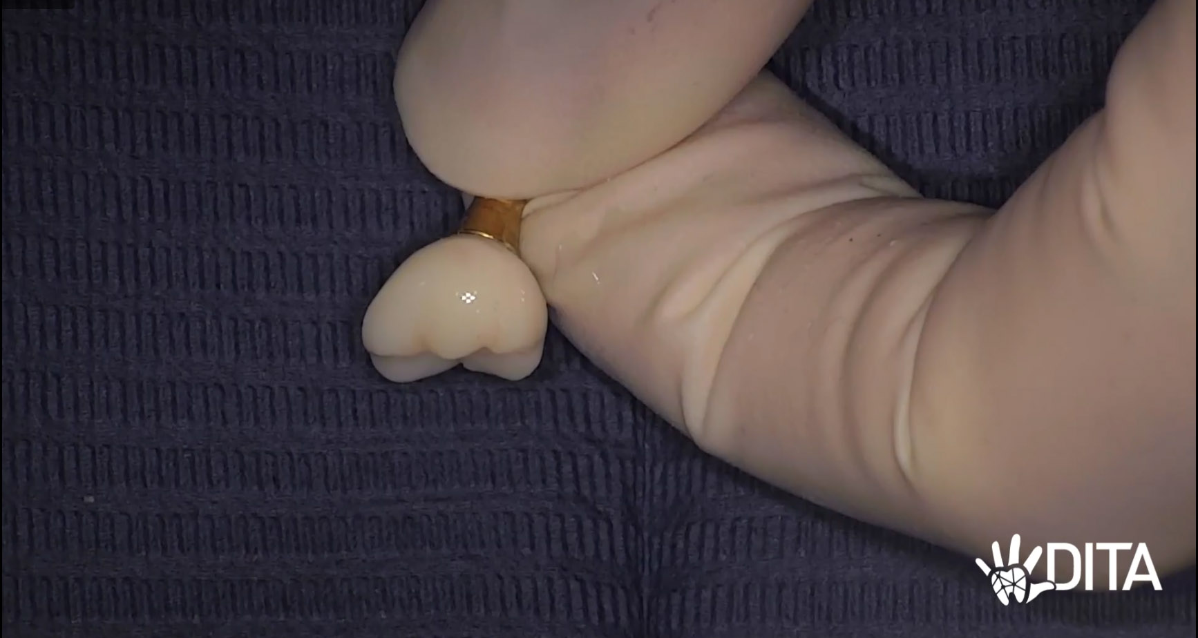 Trattamento Step by Step della Corona Stampata su Impianto